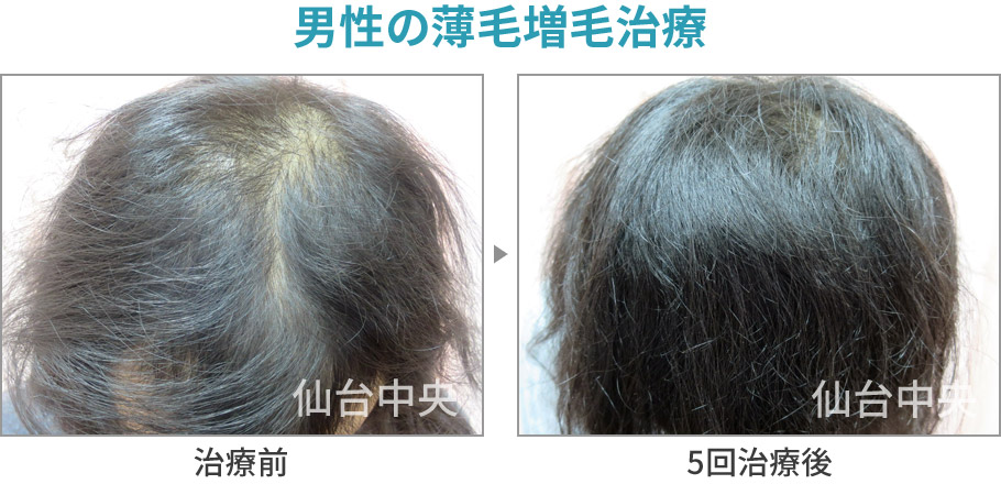 男性の薄毛増毛治療